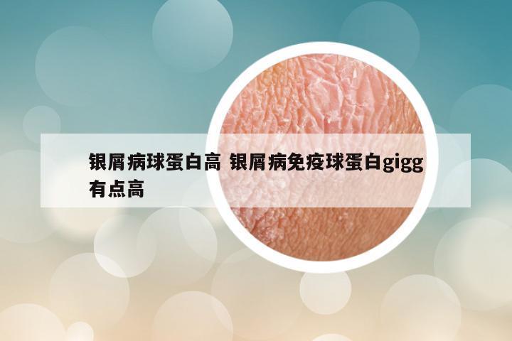 银屑病球蛋白高 银屑病免疫球蛋白gigg有点高