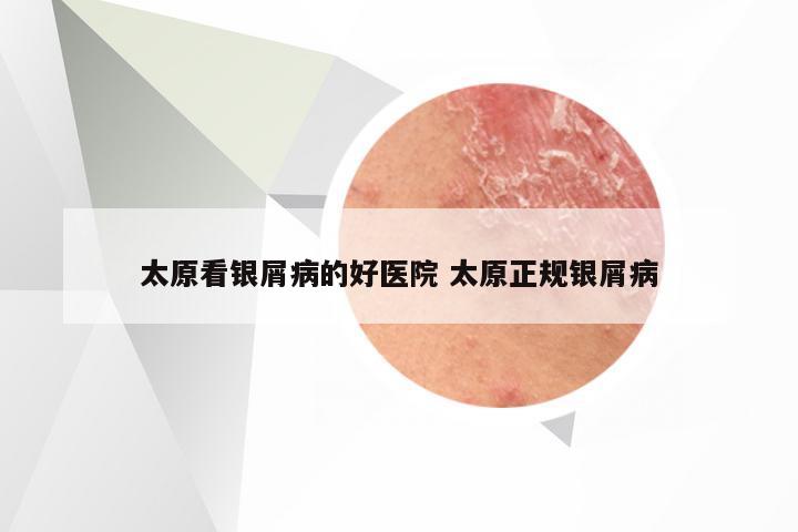 太原看银屑病的好医院 太原正规银屑病