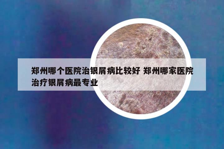郑州哪个医院治银屑病比较好 郑州哪家医院治疗银屑病最专业