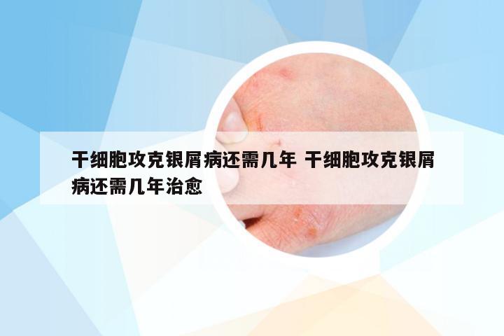 干细胞攻克银屑病还需几年 干细胞攻克银屑病还需几年治愈