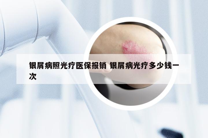 银屑病照光疗医保报销 银屑病光疗多少钱一次