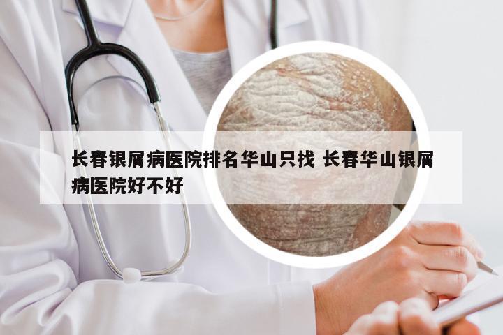 长春银屑病医院排名华山只找 长春华山银屑病医院好不好