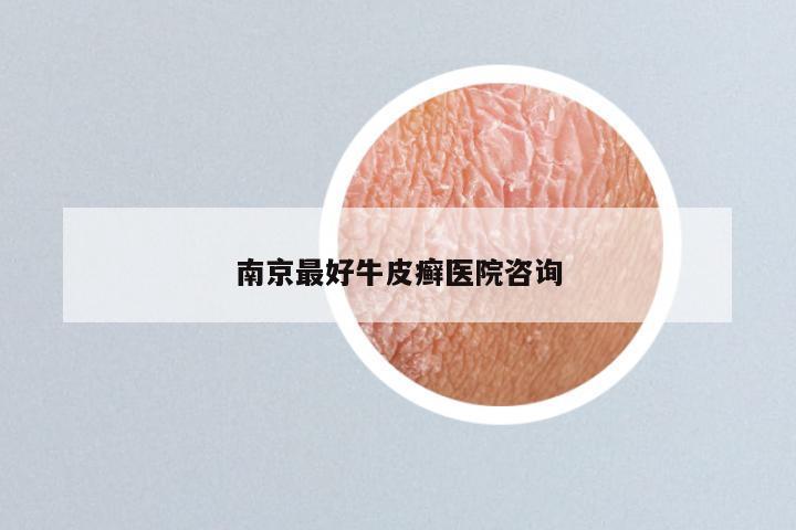南京最好牛皮癣医院咨询