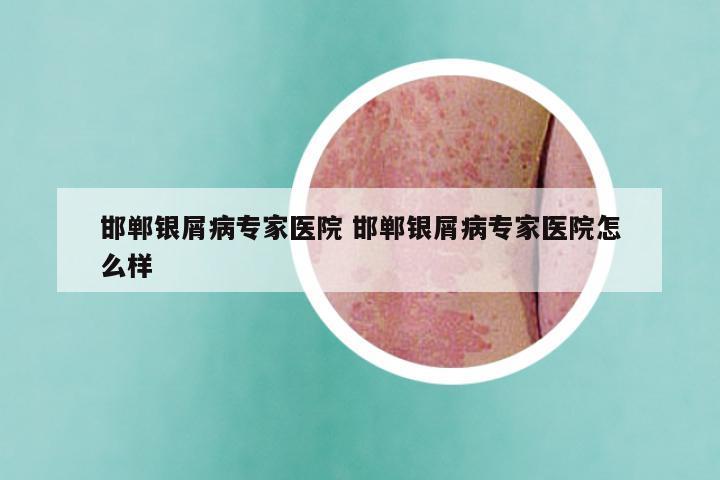 邯郸银屑病专家医院 邯郸银屑病专家医院怎么样