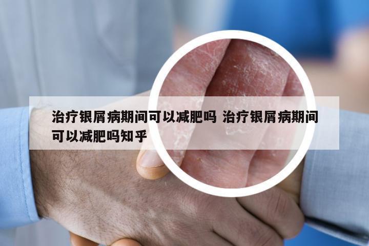 治疗银屑病期间可以减肥吗 治疗银屑病期间可以减肥吗知乎