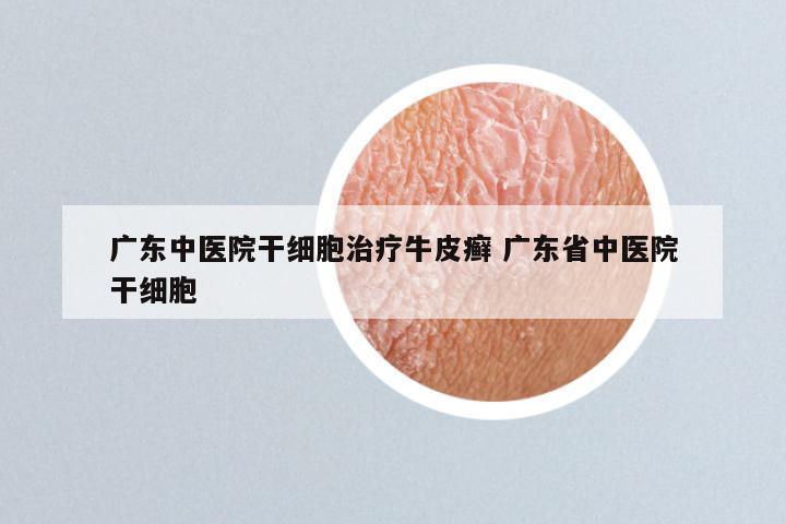 广东中医院干细胞治疗牛皮癣 广东省中医院干细胞