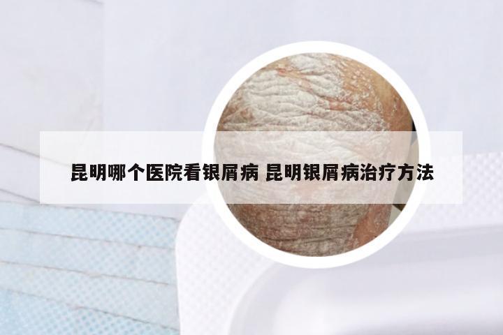 昆明哪个医院看银屑病 昆明银屑病治疗方法