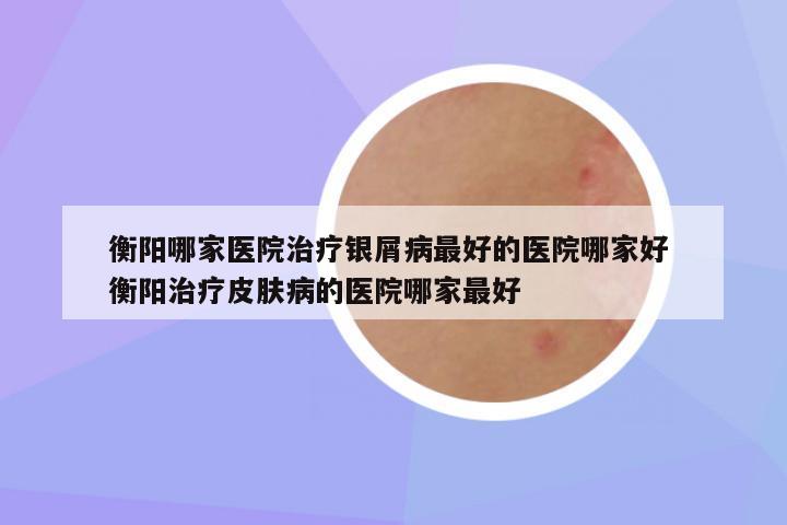 衡阳哪家医院治疗银屑病最好的医院哪家好 衡阳治疗皮肤病的医院哪家最好