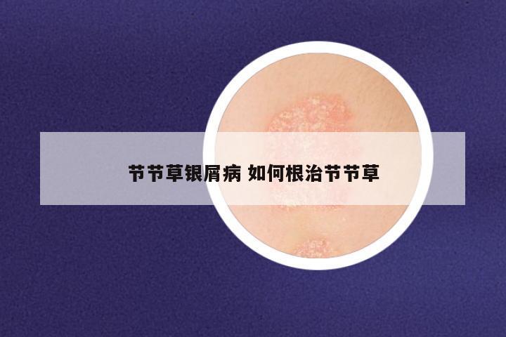 节节草银屑病 如何根治节节草