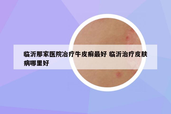 临沂那家医院冶疗牛皮癣最好 临沂治疗皮肤病哪里好