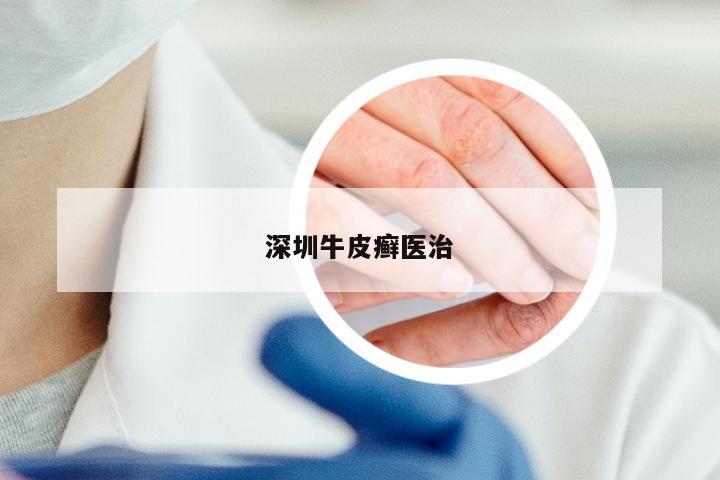 深圳牛皮癣医治