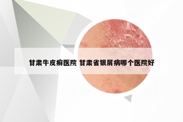 甘肃牛皮癣医院 甘肃省银屑病哪个医院好