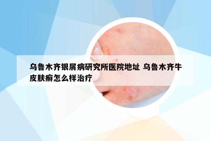 乌鲁木齐银屑病研究所医院地址 乌鲁木齐牛皮肤癣怎么样治疗