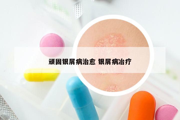 顽固银屑病治愈 银屑病冶疗