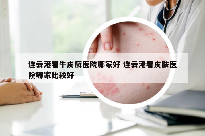 连云港看牛皮癣医院哪家好 连云港看皮肤医院哪家比较好