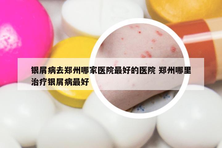 银屑病去郑州哪家医院最好的医院 郑州哪里治疗银屑病最好