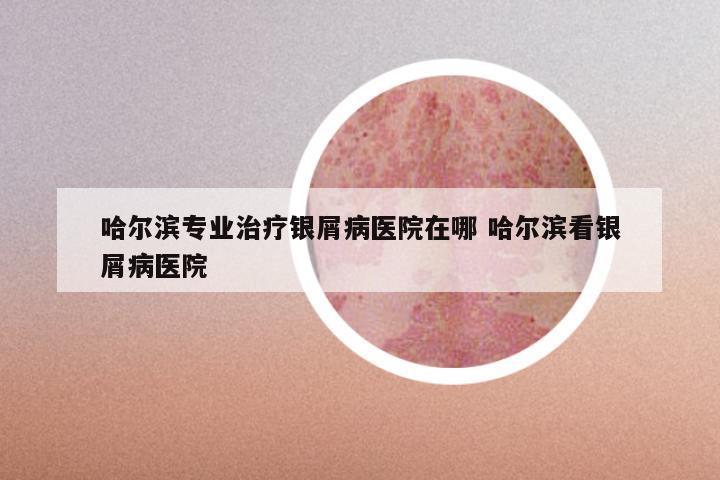 哈尔滨专业治疗银屑病医院在哪 哈尔滨看银屑病医院