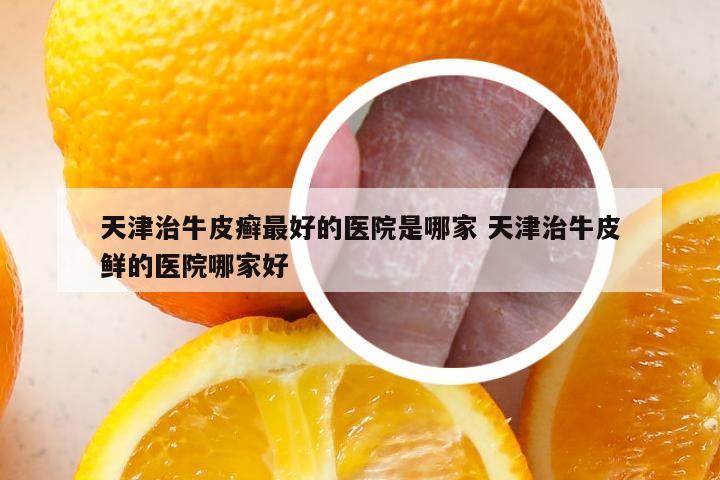 天津治牛皮癣最好的医院是哪家 天津治牛皮鲜的医院哪家好