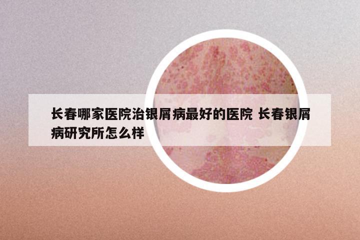 长春哪家医院治银屑病最好的医院 长春银屑病研究所怎么样