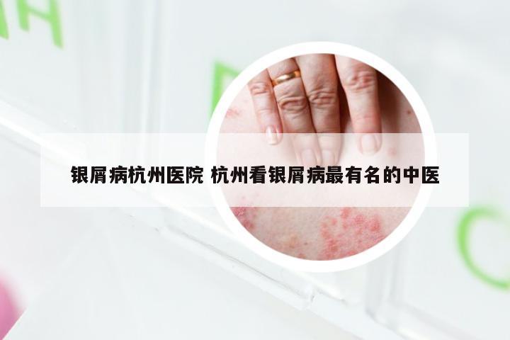 银屑病杭州医院 杭州看银屑病最有名的中医