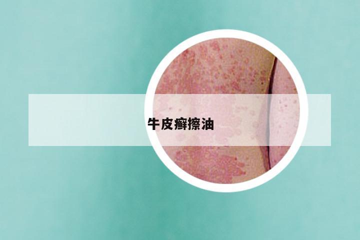 牛皮癣擦油