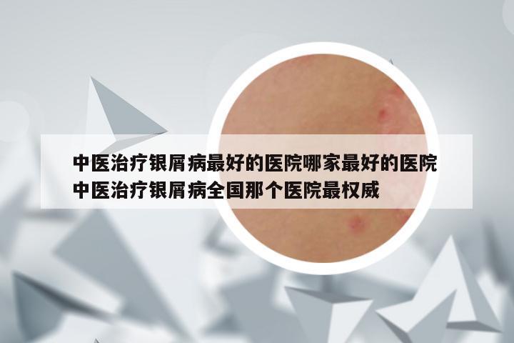 中医治疗银屑病最好的医院哪家最好的医院 中医治疗银屑病全国那个医院最权威