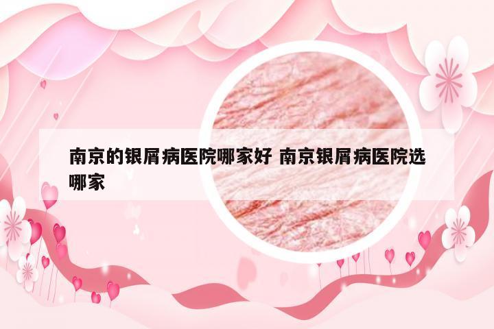 南京的银屑病医院哪家好 南京银屑病医院选哪家
