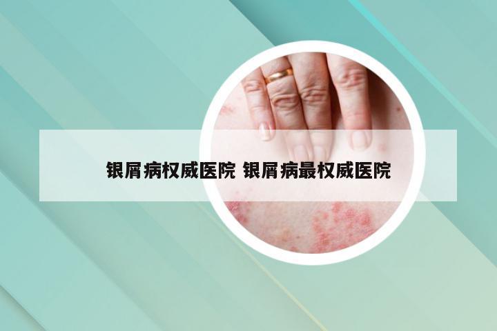 银屑病权威医院 银屑病最权威医院