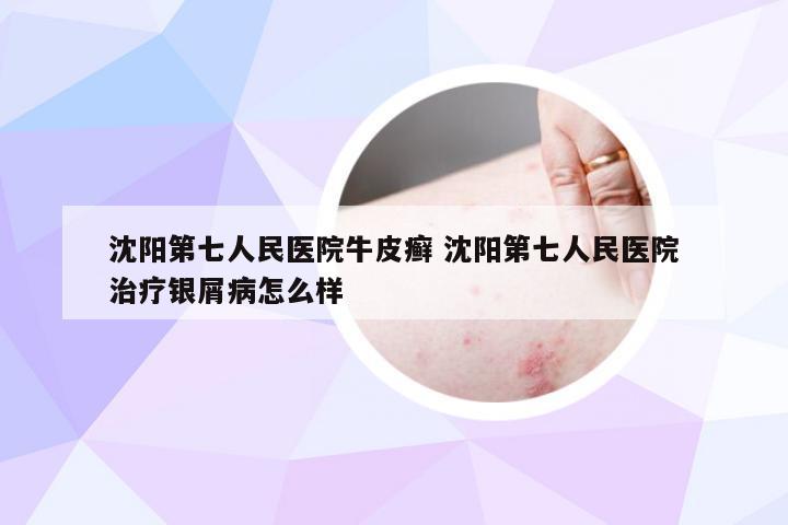 沈阳第七人民医院牛皮癣 沈阳第七人民医院治疗银屑病怎么样