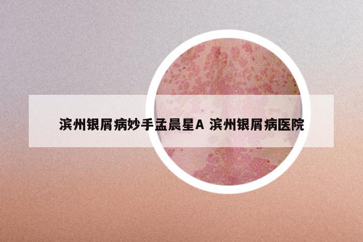 滨州银屑病妙手孟晨星A 滨州银屑病医院