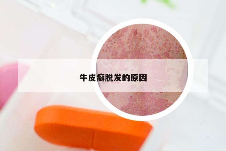 牛皮癣脱发的原因