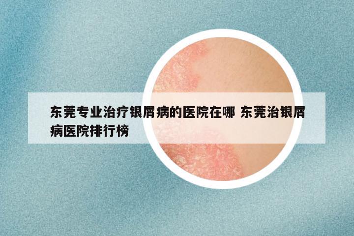东莞专业治疗银屑病的医院在哪 东莞治银屑病医院排行榜