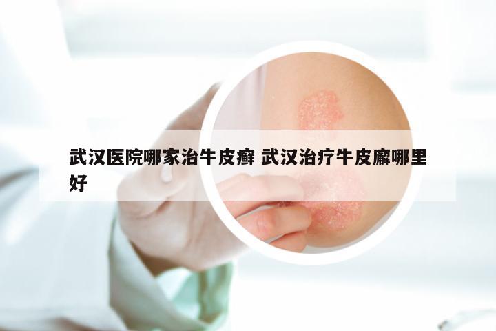武汉医院哪家治牛皮癣 武汉治疗牛皮廨哪里好
