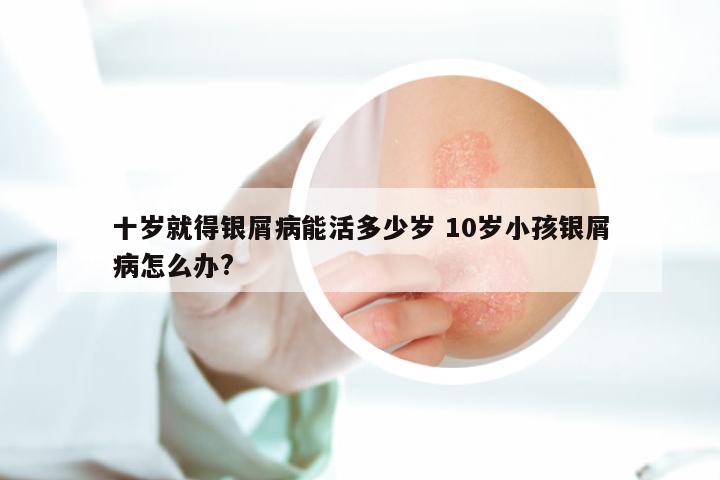 十岁就得银屑病能活多少岁 10岁小孩银屑病怎么办?