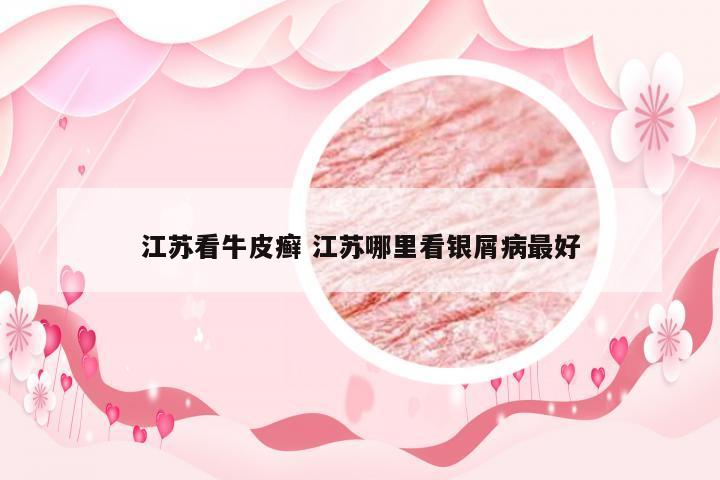 江苏看牛皮癣 江苏哪里看银屑病最好