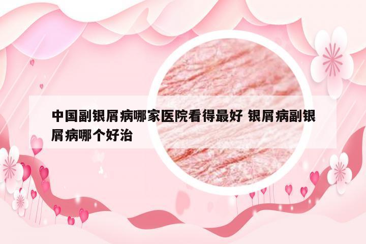 中国副银屑病哪家医院看得最好 银屑病副银屑病哪个好治