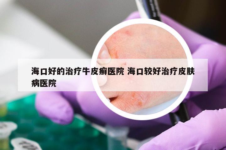 海口好的治疗牛皮癣医院 海口较好治疗皮肤病医院