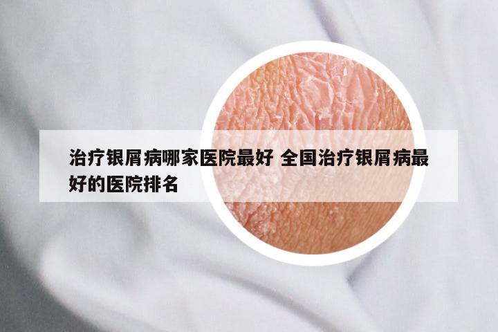治疗银屑病哪家医院最好 全国治疗银屑病最好的医院排名