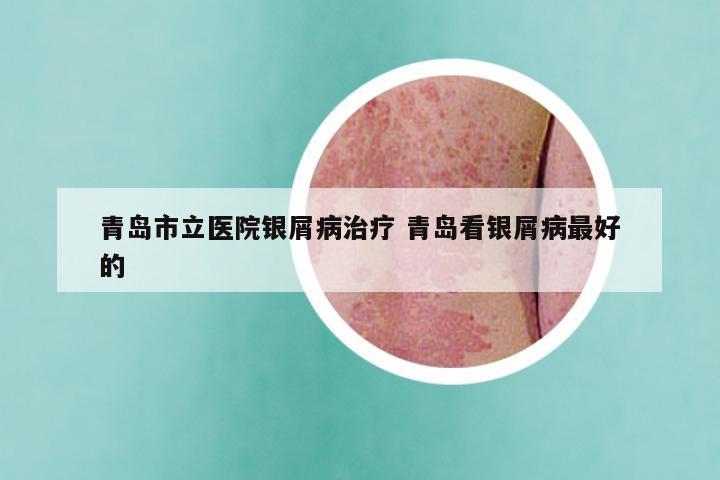 青岛市立医院银屑病治疗 青岛看银屑病最好的