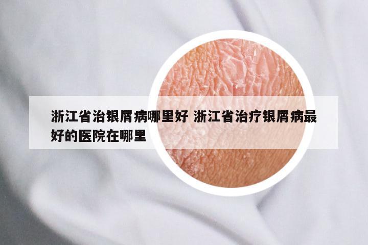 浙江省治银屑病哪里好 浙江省治疗银屑病最好的医院在哪里