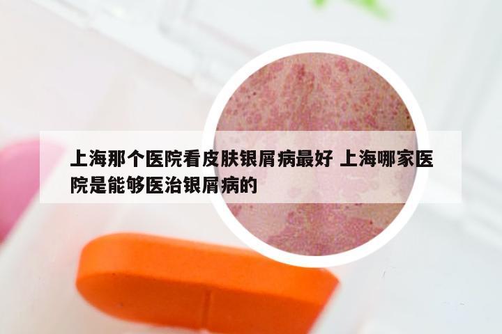 上海那个医院看皮肤银屑病最好 上海哪家医院是能够医治银屑病的