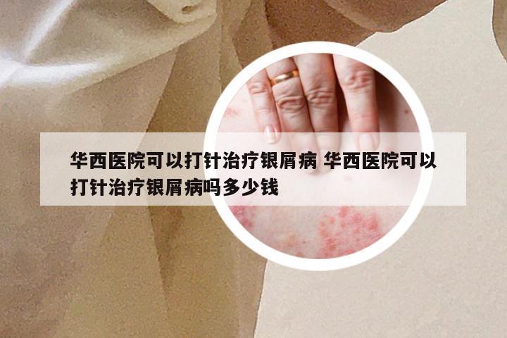 华西医院可以打针治疗银屑病 华西医院可以打针治疗银屑病吗多少钱
