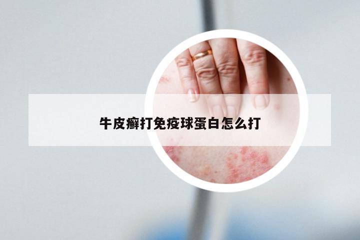 牛皮癣打免疫球蛋白怎么打