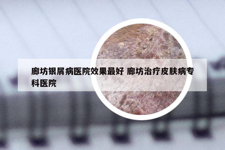 廊坊银屑病医院效果最好 廊坊治疗皮肤病专科医院