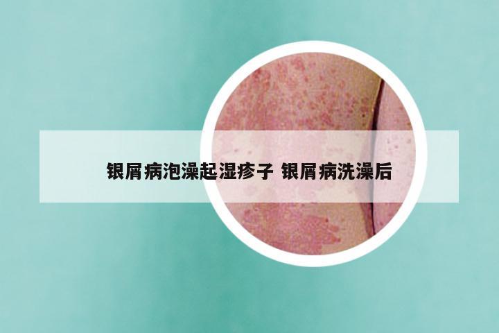 银屑病泡澡起湿疹子 银屑病洗澡后
