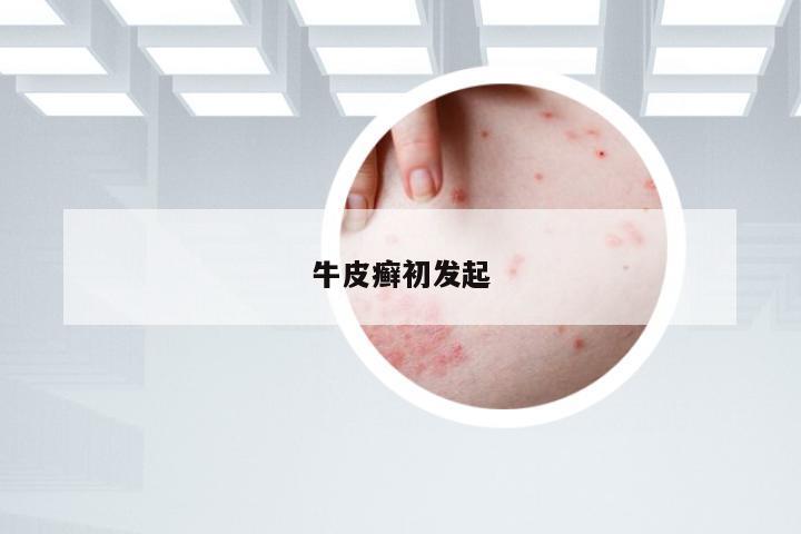 牛皮癣初发起