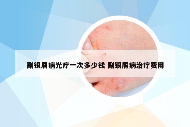 副银屑病光疗一次多少钱 副银屑病治疗费用