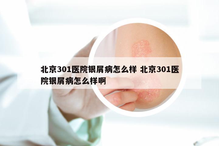 北京301医院银屑病怎么样 北京301医院银屑病怎么样啊