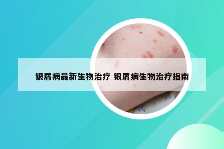 银屑病最新生物治疗 银屑病生物治疗指南