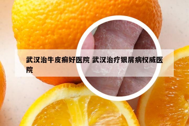 武汉治牛皮癣好医院 武汉治疗银屑病权威医院